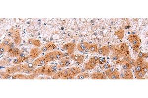 Immunohistochemistry of paraffin-embedded Human liver cancer tissue using NCAN Polyclonal Antibody at dilution of 1:30(x200) (Neurocan anticorps)