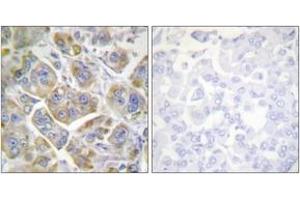 Immunohistochemistry analysis of paraffin-embedded human breast carcinoma tissue, using Integrin beta4 (Ab-1510) Antibody. (Integrin beta 4 anticorps  (AA 1481-1530))