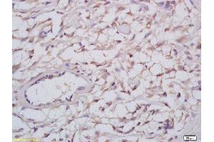 Formalin-fixed and paraffin embedded human cervical carcinoma labeled with Anti-Nogo A+B Polyclonal Antibody, Unconjugated  at 1:200 followed by conjugation to the secondary antibody and DAB staining (Reticulon 4 anticorps  (AA 251-357))