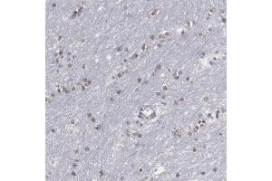 Immunohistochemical staining (Formalin-fixed paraffin-embedded sections) of human lateral ventricle with SOX11 polyclonal antibody  shows nuclear positivity in glial cells at 1:200 - 1:500 dilution. (SOX11 anticorps)