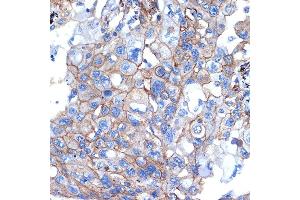 Immunohistochemistry of paraffin-embedded human lung cancer using Talin 2 Rabbit mAb (ABIN7270720) at dilution of 1:100 (40x lens). (TLN2 anticorps)