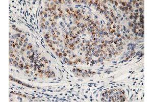Immunohistochemical staining of paraffin-embedded Carcinoma of Human pancreas tissue using anti-HOXC11 mouse monoclonal antibody. (HOXC11 anticorps)
