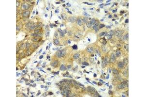 Immunohistochemistry of paraffin-embedded Human gastric cancer using DPP3 Polyclonal Antibody at dilution of 1:100 (40x lens). (DPP3 anticorps)