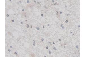 Detection of TNFaIP3 in Human Glioma Tissue using Polyclonal Antibody to Tumor Necrosis Factor Alpha Induced Protein 3 (TNFaIP3)