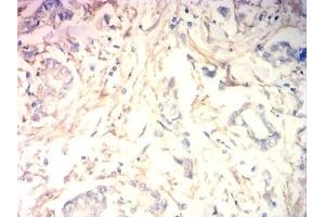Immunohistochemical analysis of paraffin-embedded human stomach cancer tissues using MB mouse mAb with DAB staining.