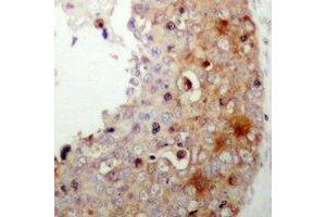 Immunohistochemical analysis of XIAP (pS87) staining in human prostate cancer formalin fixed paraffin embedded tissue section. (XIAP anticorps  (pSer87))