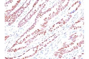 Formalin-fixed, paraffin-embedded human Colon Carcinoma stained with p57 Monoclonal Antibody (KP10). (CDKN1C anticorps)