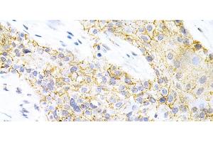 Immunohistochemistry of paraffin-embedded Human esophageal cancer using PPP2R4 Polyclonal Antibody at dilution of 1:200 (40x lens). (PPP2R4 anticorps)