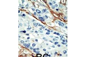 Formalin-fixed and paraffin-embedded human cancer tissue reacted with the primary antibody, which was peroxidase-conjugated to the secondary antibody, followed by DAB staining. (NUAK1 anticorps  (C-Term))