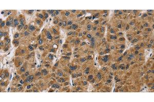 Immunohistochemistry of paraffin-embedded Human liver cancer tissue using IL19 Polyclonal Antibody at dilution 1:40 (IL-19 anticorps)