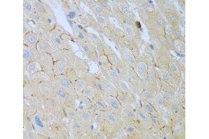 Immunohistochemistry of paraffin-embedded Human liver cancer using CEACAM7 Polyclonal Antibody at dilution of 1:100 (40x lens). (CEACAM7 anticorps)