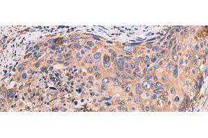 Immunohistochemistry of paraffin-embedded Human cervical cancer tissue using GUSB Polyclonal Antibody at dilution of 1:50(x200) (Glucuronidase beta anticorps)