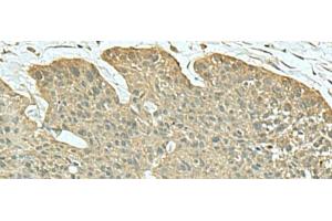 Immunohistochemistry of paraffin-embedded Human esophagus cancer tissue using FN3KRP Polyclonal Antibody at dilution of 1:55(x200) (FN3KRP anticorps)