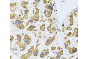 Immunohistochemistry of paraffin-embedded Human liver cancer using BTD Polyclonal Antibody at dilution of 1:100 (40x lens).