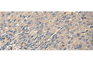 Immunohistochemistry of paraffin-embedded Human liver cancer tissue using ZG16 Polyclonal Antibody at dilution of 1:95(x200)
