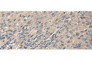 Immunohistochemistry of paraffin-embedded Human liver cancer tissue using ZG16 Polyclonal Antibody at dilution of 1:95(x200) (ZG16 anticorps)