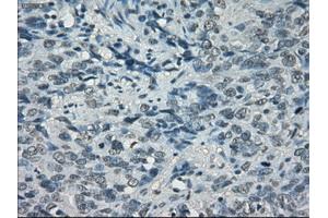 Immunohistochemical staining of paraffin-embedded Carcinoma of bladder tissue using anti-PORmouse monoclonal antibody. (POR anticorps)