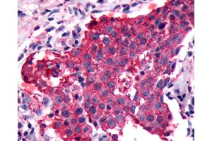 Anti-PGR1 / GPR153 antibody IHC of human Breast, Carcinoma. (GPR153 anticorps  (Extracellular Domain))