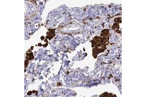 Immunohistochemical staining (Formalin-fixed paraffin-embedded sections) of human lung with MSR1 polyclonal antibody  shows strong cytoplasmic positivity in macrophages at 1:50 - 1:200 dilution. (Macrophage Scavenger Receptor 1 anticorps)