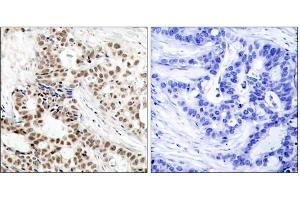Immunohistochemical analysis of paraffin-embedded human breast carcinoma tissue, using BRCA1 (phospho-Ser1423) antibody (E011242). (BRCA1 anticorps  (pSer1423))
