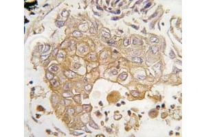 IHC analysis of FFPE human lung carcinoma tissue stained with CYP1A1 antibody
