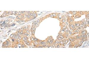 Immunohistochemistry of paraffin-embedded Human gastric cancer tissue using CCL5 Polyclonal Antibody at dilution of 1:50(x200) (CCL5 anticorps)