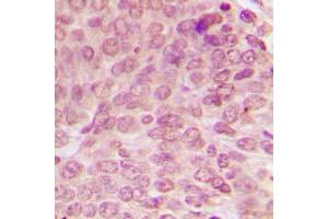 Immunohistochemical analysis of p53 (pS15) staining in human breast cancer formalin fixed paraffin embedded tissue section. (p53 anticorps  (N-Term, pSer15))