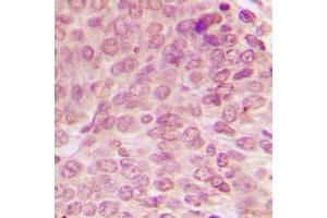 Immunohistochemical analysis of p53 (pS15) staining in human breast cancer formalin fixed paraffin embedded tissue section. (p53 anticorps  (N-Term, pSer15))