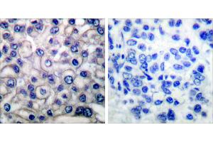 Peptide - +Immunohistochemical analysis of paraffin-embedded human breast carcinoma tissue using EGFR (Ab-693) antibody (#B0009). (EGFR anticorps  (Thr693))