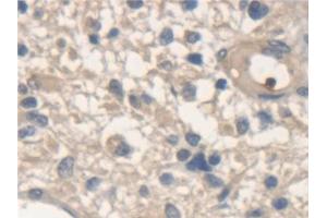 Detection of NSF in Human Glioma Tissue using Polyclonal Antibody to N-Ethylmaleimide Sensitive Factor (NSF)