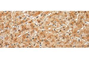 Immunohistochemistry of paraffin-embedded Human liver cancer tissue using DRD3 Polyclonal Antibody at dilution of 1:25(x200) (DRD3 anticorps)