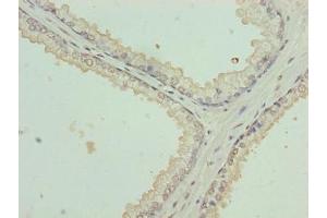 Immunohistochemistry of paraffin-embedded human prostate cancer using ABIN7157364 at dilution of 1:100 (Keratin 35 anticorps  (AA 1-455))