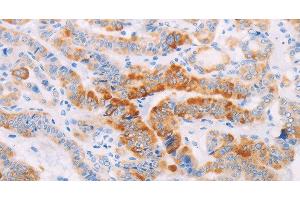 Immunohistochemistry of paraffin-embedded Human thyroid cancer using MAP4K3 Polyclonal Antibody at dilution of 1:30 (MAP4K3 anticorps)