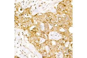Immunohistochemistry of paraffin-embedded human breast cancer using B1 Rabbit pAb (ABIN6129916, ABIN6136962, ABIN6136963 and ABIN6222795) at dilution of 1:150 (40x lens). (AP3B1 anticorps  (AA 895-1094))