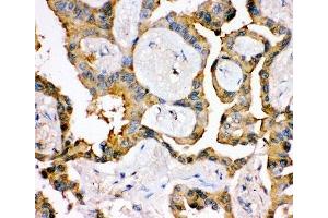IHC-P: IRS1 antibody testing of human lung cancer tissue (IRS1 anticorps  (AA 1041-1242))