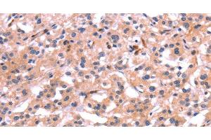 Immunohistochemistry of paraffin-embedded Human thyroid cancer tissue using PTPN13 Polyclonal Antibody at dilution 1:30 (PTPN13 anticorps)