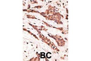 Formalin-fixed and paraffin-embedded human cancer tissue reacted with LPAR2 polyclonal antibody  , which was peroxidase-conjugated to the secondary antibody, followed by AEC staining. (EDG4 anticorps  (N-Term))