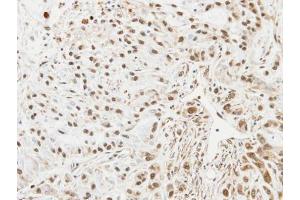 IHC-P Image Immunohistochemical analysis of paraffin-embedded A549 xenograft, using UBE2L3, antibody at 1:100 dilution. (UBE2L3 anticorps  (C-Term))