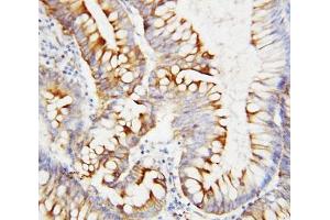 IHC-P: SPARC antibody testing of human intestinal cancer tissue