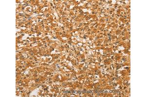 Immunohistochemistry of Human colon cancer using BCL2L14 Polyclonal Antibody at dilution of 1:40 (BCL2L14 anticorps)