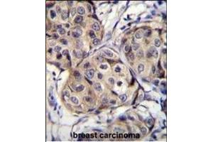 CBLN2 Antibody (C-term) (ABIN655780 and ABIN2845215) immunohistochemistry analysis in formalin fixed and paraffin embedded human breast carcinoma followed by peroxidase conjugation of the secondary antibody and DAB staining. (CBLN2 anticorps  (C-Term))
