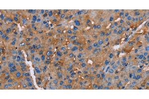 Immunohistochemistry of paraffin-embedded Human liver cancer tissue using NLGN1 Polyclonal Antibody at dilution 1:50 (Neuroligin 1 anticorps)