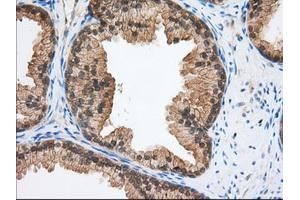 Immunohistochemical staining of paraffin-embedded Adenocarcinoma of Human ovary tissue using anti-TACC3 mouse monoclonal antibody. (TACC3 anticorps)