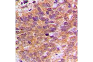 Immunohistochemical analysis of ABL1 staining in human breast cancer formalin fixed paraffin embedded tissue section. (ABL1 anticorps  (C-Term))