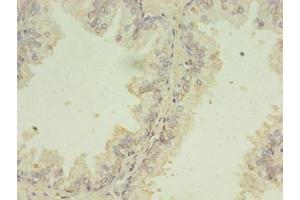 Immunohistochemistry of paraffin-embedded human prostate cancer using ABIN7174153 at dilution of 1:100