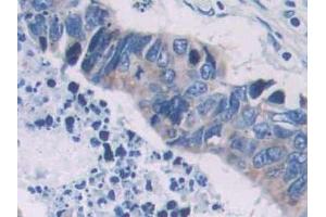 IHC-P analysis of Human Colorectal cancer Tissue, with DAB staining. (PCOLCE anticorps  (AA 315-437))