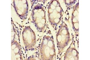 Immunohistochemistry of paraffin-embedded human colon cancer using ABIN7175909 at dilution of 1:100 (XPNPEP1 anticorps  (AA 2-623))