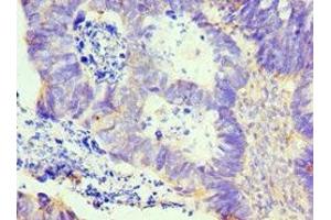 Immunohistochemistry of paraffin-embedded human ovarian cancer using ABIN7157975 at dilution of 1:100