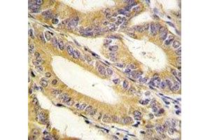 IHC analysis of FFPE human colon carcinoma tissue stained with XIAP antibody