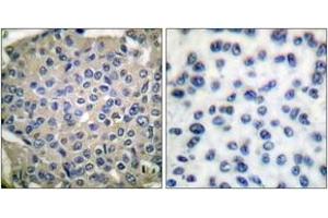 Immunohistochemistry analysis of paraffin-embedded human breast carcinoma, using Cortactin (Phospho-Tyr466) Antibody. (Cortactin anticorps  (pTyr466))